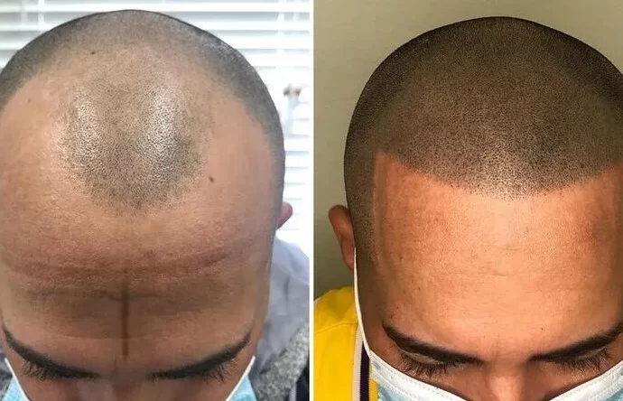 micropigmentation